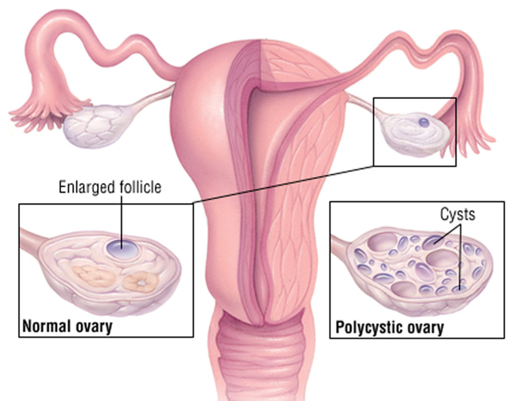 Meaning pcos Polycystic ovary